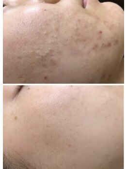 アンジェロ/【ニキビケア】肌育プログラム