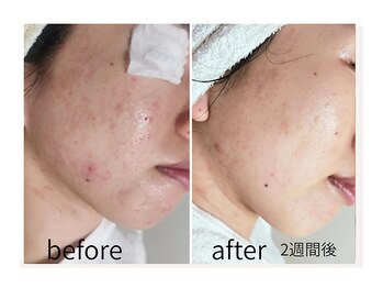 キレイラボ(Ki-Re-i LABO)/短期間でニキビを改善