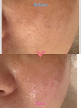 リノエデボーテ(Rinoe’ de beaute)の写真/【セルラム/毛穴の目立ち・キメの乱れに】内側から満たされるハリ感で、滑らかな陶器肌へ整えます！