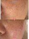 リノエデボーテ(Rinoe’ de beaute)の写真/【セルラム/毛穴の目立ち・キメの乱れに】内側から満たされるハリ感で、滑らかな陶器肌へ整えます！