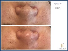 ひかり素肌/毛穴ケア1回