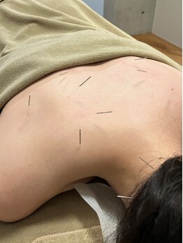 ロウエン(LAUEN)の写真/完全オーダーメイド施術で根本原因から改善！自律神経の乱れにも◎鍼灸＋ボディケアメニューもあり♪
