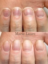 マリーロール 梅田店(Marie Laure)/深爪矯正/自爪育成/自爪風
