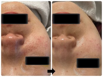 エフェクト 塚口店(effect)/Before After 30代/2回目