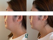 グレイスリリー(grace lily)/