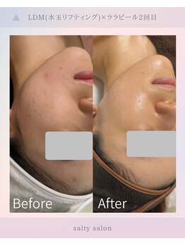 ソルティ サロン(salty salon)/LDM×ララピール2回目