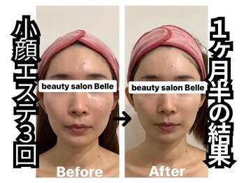 ベル 心斎橋店(Belle)/光糸リフト小顔/ほうれい線ケア