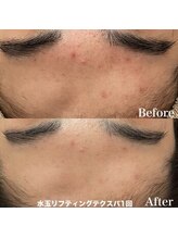 ヴェアリー 広尾(VARY)/おでこのニキビ