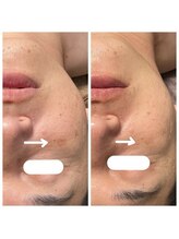 きこりのいずみ/男性にもオススメ光フェイシャル