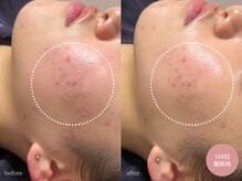 ラティエ(Latier)/ハーブピーリング1回目