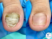プラスワンフット 本厚木(+1 Foot)の雰囲気（【肥厚爪】は放置しないで！爪が剥がれたり割れるなどトラブルに）