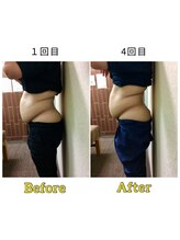 マリモ鍼灸接骨院/電磁パルス週1回　4回目の結果