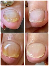 ルミエール(_Lumiere)/巻き爪ケア