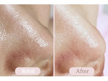 エピル(EPIL)/DEEPクリアスキン毛穴洗浄症例