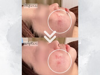 サイバーエステ 宇都宮店/くすみ肌・赤みケア