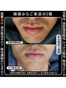 ディースタイル 北谷店(Dstyle)/北谷メンズ脱毛ヒゲBefore After
