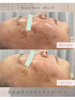 ベルーチェ(BELUCE)/タラソパックでミネラル補給