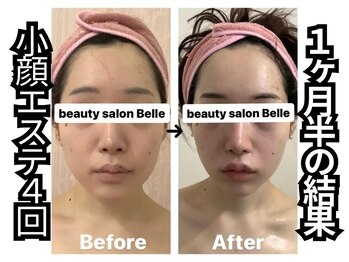 ベル 心斎橋店(Belle)/光糸リフト小顔/ほうれい線ケア