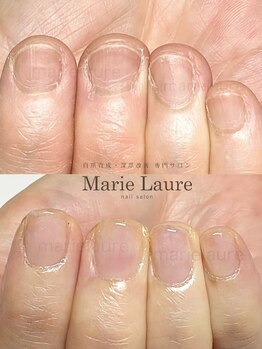 マリーロール 梅田店(Marie Laure)/自爪育成/深爪矯正/ネイルケア