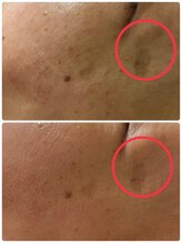 ルーメ(lume)/シミケア50代女性