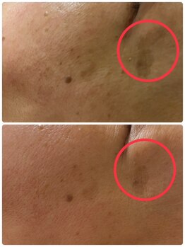 ルーメ(lume)/シミケア50代女性