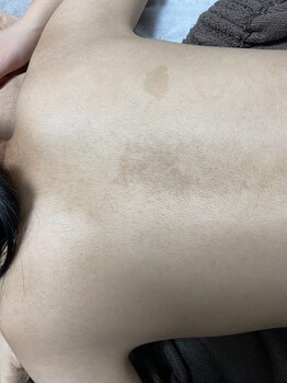 カルム(calm.)/背中脱毛前