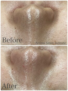 アンティミテ(Intimite)/毛穴洗浄1回の変化