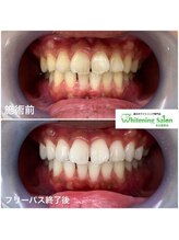 ホワイトニングサロン 名古屋駅店/【ホワイトニング施術例】
