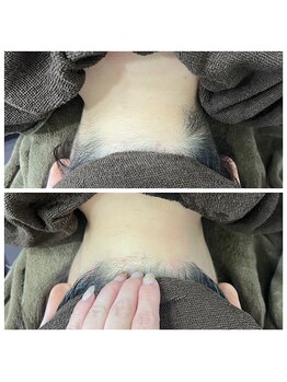 ミース 北九州店/「うなじビフォーアフター」