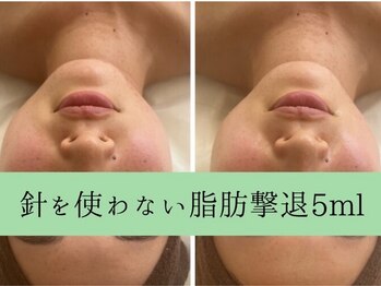 ソルニス(Solnis.)/小顔☆脂肪分解/ハイパーナイフ