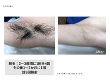 トータルクリア(TOTAL CLEAR)/男性ワキ脱毛