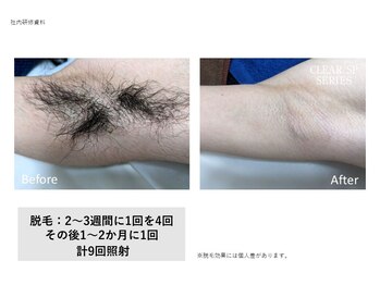 トータルクリア(TOTAL CLEAR)/男性ワキ脱毛