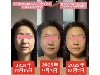 痩身ハイパーナイフメンズ【salon blue rose】新栄町/千種/痩身/ダイエット/脂肪燃焼/小顔に特化/リフトアップ/名古屋