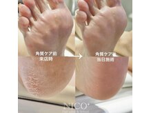 ニコプラス(NICO+)/足裏角質除去