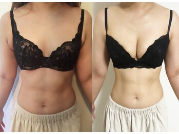 カナエルサロン 旭川(KANAERU SALON)/【バスト残しダイエット】症例☆