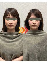 ヴィオラプラス(violla Plus+)/小顔矯正リンパ　初回価格¥2800