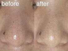 アルム(a'lm)/毛穴の黒ずみが気になる方へ