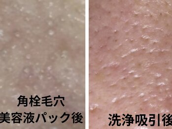 コハク(kohaku)/鼻すっきり毛穴コースで角栓オフ