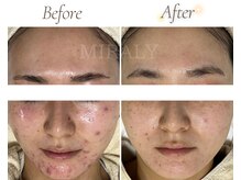 ミラリー(MIRALY)/敏感・ニキビケア 12ヶ月(20代)