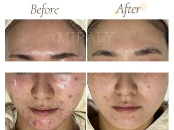 ミラリー(MIRALY)/敏感・ニキビケア 12ヶ月(20代)