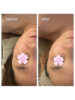 美温(mion)/インディバフェイシャル×肌別P