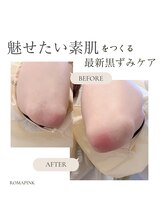 リシェリ 代官山(RICHERI)/ローマピンク両肘1回の症例