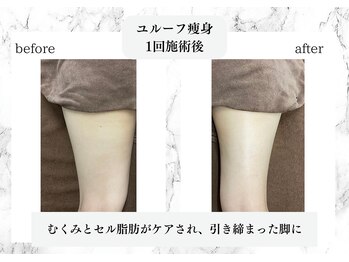 トキ(TOKI)/ユルーフ超音波痩身 太もも