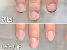 グラシュータン(gracieux temps)/【深爪矯正13000円】