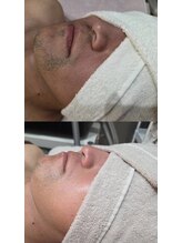 エンルーチェ プラスエイト(en;Luce+8)/髭脱毛3回目