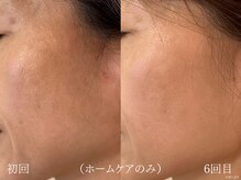 ウォーム(warm)/シワケア/小顔/マッサージ/小顔