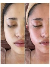 ロッシュ フェイス(Roche Face)/ボンバークリーム