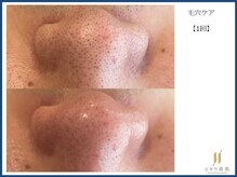 ひかり素肌/毛穴ケア1回