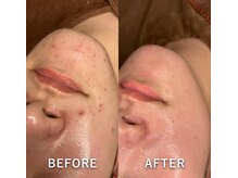 〈ハーブピーリング変化〉パック中は気持ち良いマッサージ有