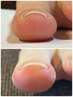【巻き爪１本 ¥6600】ジェルで巻き爪ケア★